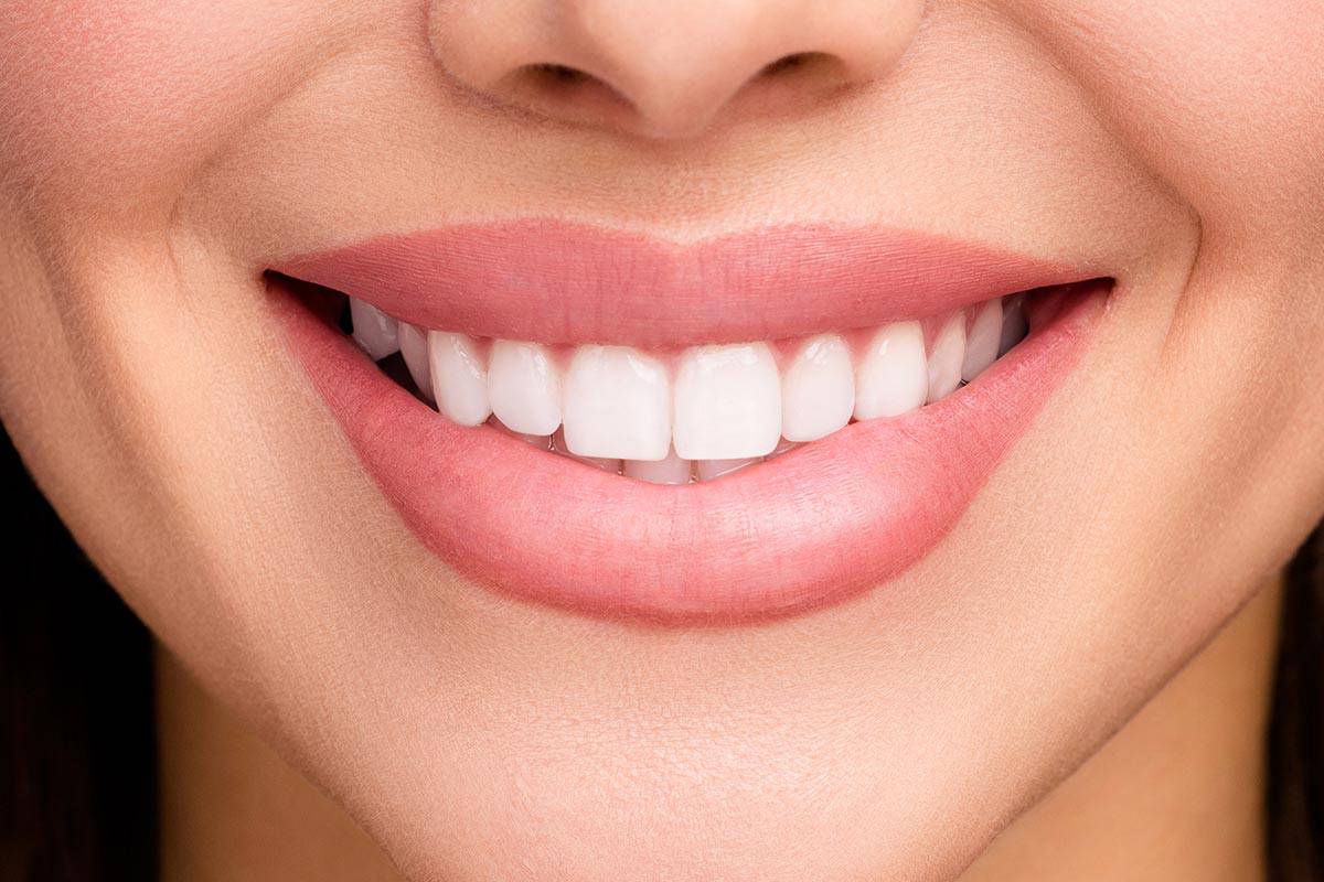 mm hollywood smile 00