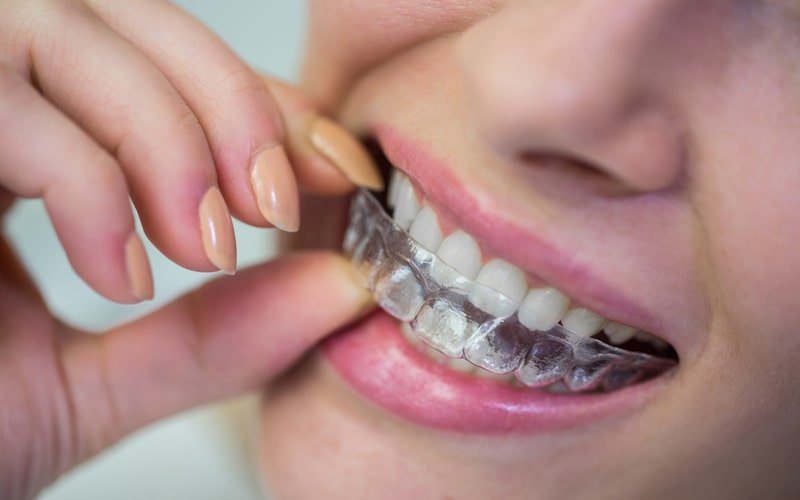 hangi durumlarda invisalign tedavisi uygulanir