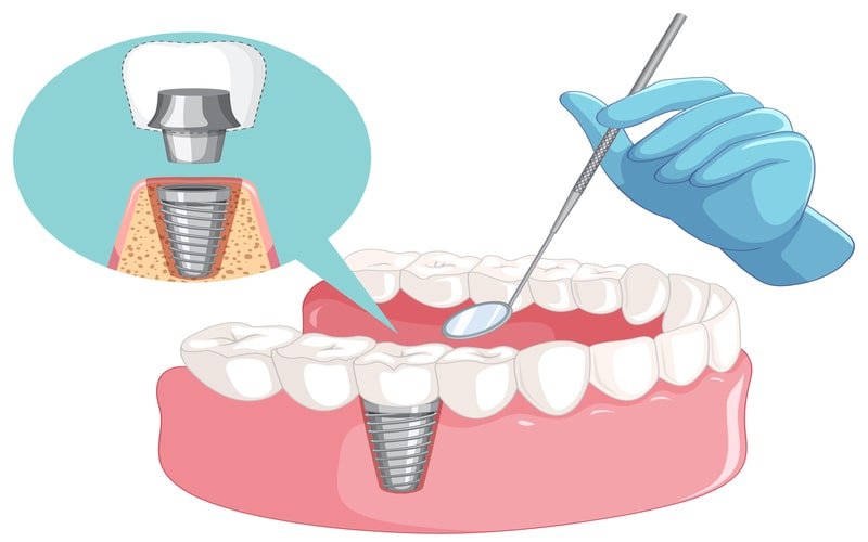Çizim: alt çenede vidalı implant ve ağız aynası, yanda implant kesiti