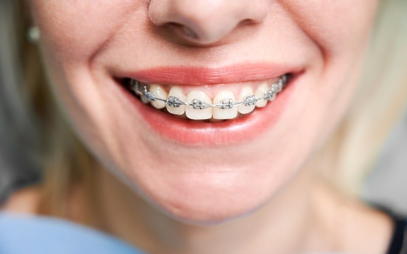Metal braketli gülümseme, üst ve alt çenede tel ve braketler görünüyor