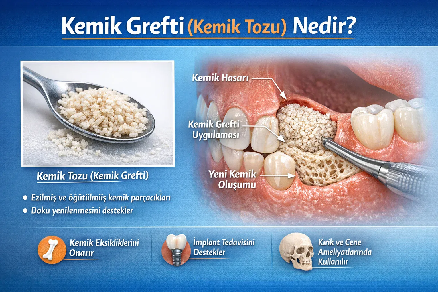 Kaşıkta granül taneleri, çene kesitinde uygulama ve yeni doku oluşumunu gösteren mavi zeminli infografik