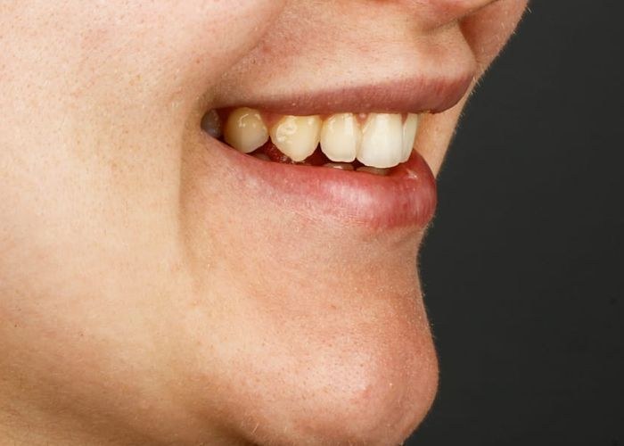 7 numaralı vaka · tedavi öncesi ağız içi yakın çekim