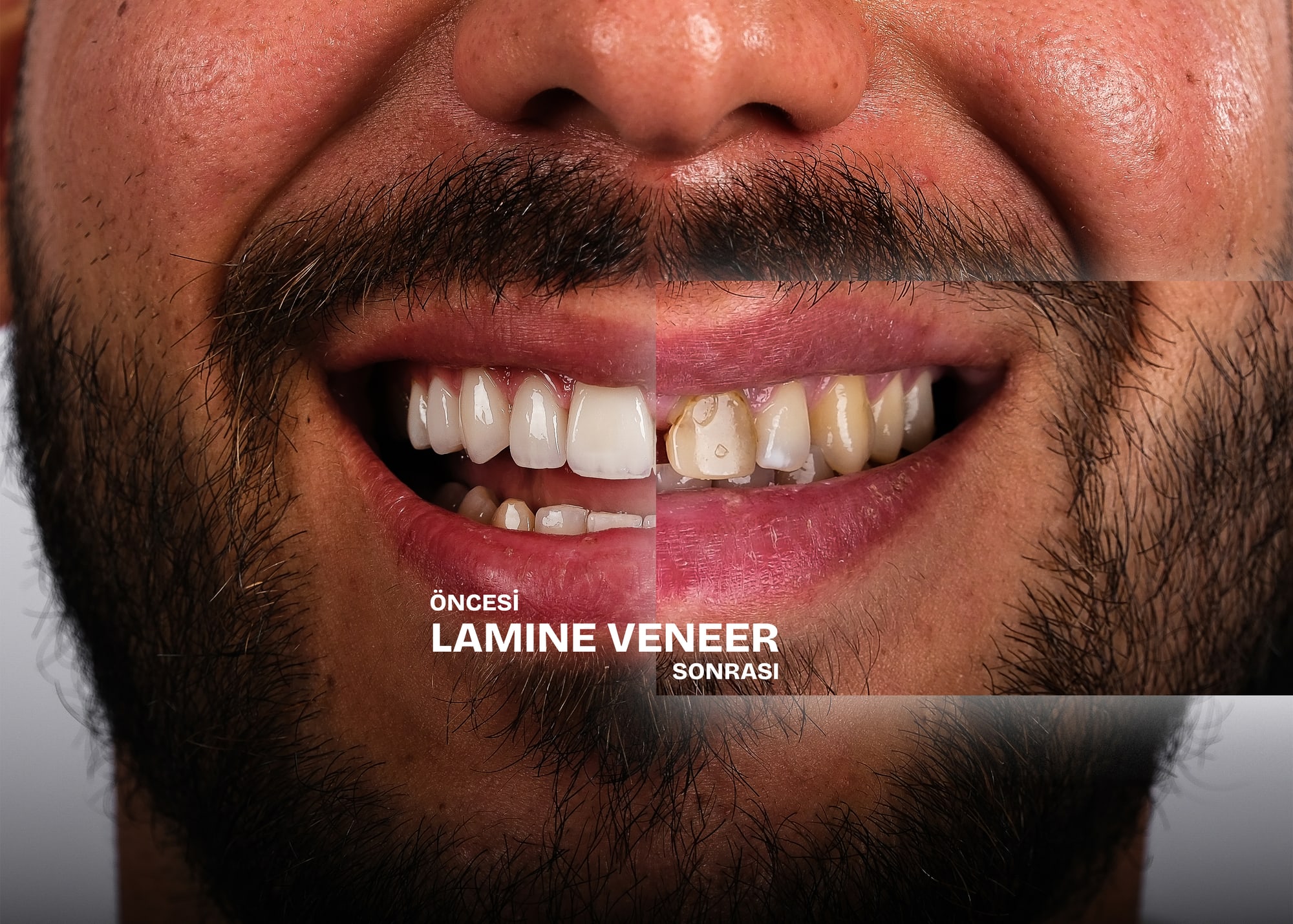 Lamine veneer öncesi ve sonrası: aynı gülüşün iki hâli yan yana