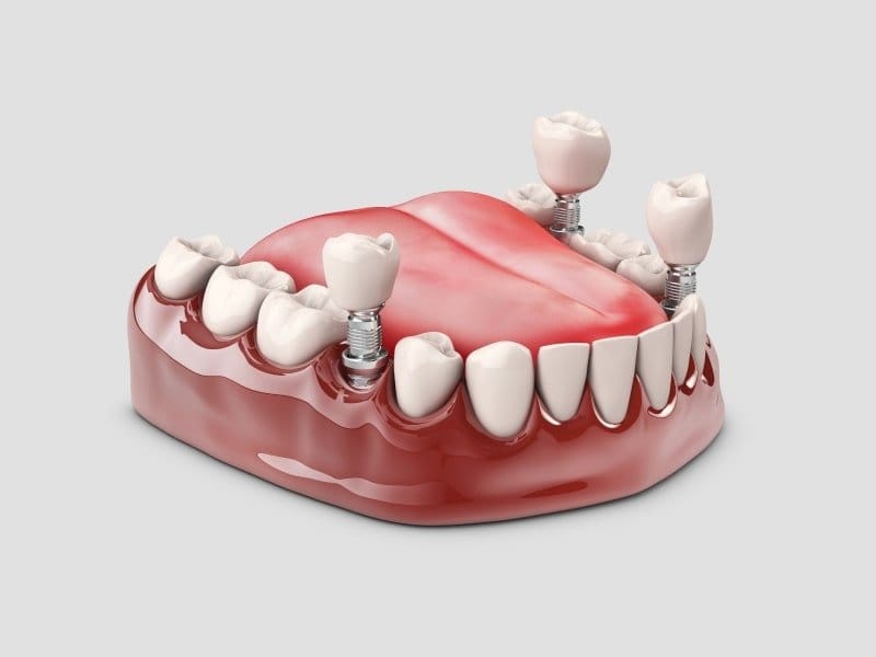 Pembe diş eti modeli üzerinde yerleştirilmiş implantlar ve kronlar